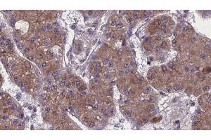ABIN6272759 at 1/100 staining Human liver cancer tissue by IHC-P.