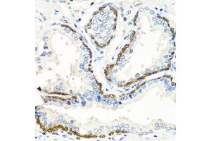 Immunohistochemistry of paraffin-embedded human prostate using BMP5 antibody. (BMP5 抗体)