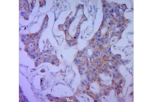 Paraformaldehyde-fixed, paraffin embedded human cervical cancer, Antigen retrieval by boiling in sodium citrate buffer (pH6. (MUC16 抗体  (AA 250-350))
