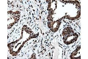 Immunohistochemical staining of paraffin-embedded Adenocarcinoma of ovary tissue using anti-PSMC3 mouse monoclonal antibody. (PSMC3 抗体)