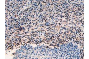 IHC-P analysis of Human Skin Cancer Tissue, with DAB staining. (GRK2 抗体  (AA 398-640))
