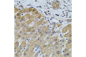 Immunohistochemistry of paraffin-embedded human liver injury using FOXO3 antibody (ABIN2736768) at dilution of 1:100 (40x lens). (FOXO3 抗体)