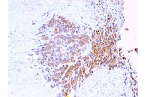 Formalin-fixed, paraffin-embedded human Melanoma stained with Topo I, MT Mouse Monoclonal Antibody (TOP1MT/568) (TOP1MT 抗体)