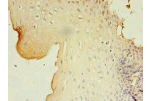 Immunohistochemistry of paraffin-embedded human cervical cancer using ABIN7153277 at dilution of 1:100 (GKAP1 抗体  (AA 21-366))