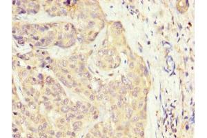 IHC image of ABIN7170156 diluted at 1:300 and staining in paraffin-embedded human liver cancer performed on a Leica BondTM system. (SLC22A25 抗体  (AA 31-145))