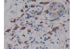 Detection of LAT2 in Human Pancreatic cancer Tissue using Polyclonal Antibody to Linker For Activation Of T-Cells Family, Member 2 (LAT2) (LAT2 抗体  (AA 30-209))