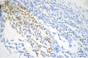 Immunohistochemistry was performed on paraffin-embedded human sigmoid colon carcinoma using DUT antibody (ABIN7798312), 1:200). (Recombinant Deoxyuridine Triphosphatase (DUT) 抗体)