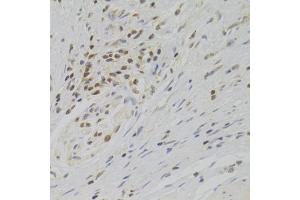Immunohistochemistry of paraffin-embedded human gastric cancer using TAF1C Antibody (ABIN2560282) at dilution of 1:100 (40x lens). (TAF1C 抗体)