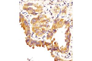 (ABIN657607 and ABIN2846604) staining SFTPC in human lung adenocarcinoma sections by Immunohistochemistry (IHC-P - paraformaldehyde-fixed, paraffin-embedded sections). (Surfactant Protein C 抗体  (C-Term))