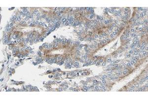 ABIN6268879 at 1/100 staining Human prostate tissue by IHC-P. (Actin 抗体  (N-Term))