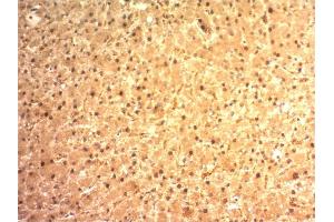 Formalin-fixed, paraffin-embedded human Hepatocellular Carcinoma stained with ARG1 Mouse Monoclonal Antibody (ARG1/1125). (Liver Arginase 抗体  (AA 11-97))