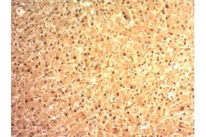 Formalin-fixed, paraffin-embedded human Hepatocellular Carcinoma stained with ARG1 Mouse Monoclonal Antibody (ARG1/1125).