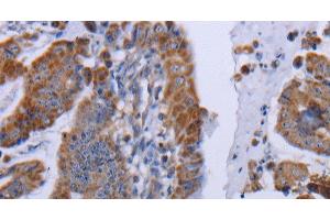 Immunohistochemistry of paraffin-embedded Human esophagus cancer tissue using MT3 Polyclonal Antibody at dilution 1:50 (MT3 抗体)