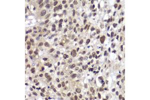 Immunohistochemistry of paraffin-embedded human lung cancer using CHEK2 antibody at dilution of 1:100 (400x lens). (CHEK2 抗体)