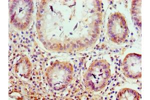 Immunohistochemistry of paraffin-embedded human colon cancer using ABIN7176599 at dilution of 1:100 (TRIM27 抗体  (AA 214-513))