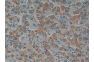 Detection of EDN1 in Human Liver cancer Tissue using Polyclonal Antibody to Endothelin 1 (EDN1) (Endothelin 1 抗体  (AA 53-90))