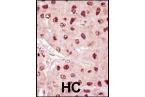 Formalin-fixed and paraffin-embedded human cancer tissue reacted with the primary antibody, which was peroxidase-conjugated to the secondary antibody, followed by DAB staining. (MEK1 抗体  (N-Term))