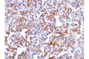 Formalin-fixed, paraffin-embedded human Histiocytoma stained with CD68 Mouse Monoclonal Antibody (LAMP4/824). (CD68 抗体)