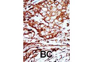Formalin-fixed and paraffin-embedded human breast cancer tissue reacted with YWHAB polyclonal antibody  , which was peroxidase-conjugated to the secondary antibody, followed by AEC staining. (YWHAB 抗体  (C-Term))
