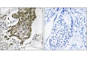 Immunohistochemistry analysis of paraffin-embedded human breast carcinoma tissue, using RABEP1 Antibody. (RABEP1 抗体  (AA 549-598))
