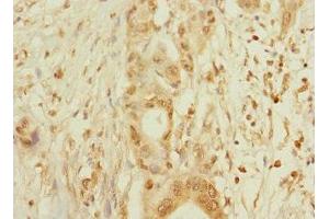 Immunohistochemistry of paraffin-embedded human pancreatic cancer using ABIN7160425 at dilution of 1:100 (MPZL2 抗体  (AA 30-140))