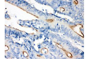 Anti- Villin Picoband antibody,IHC(P) IHC(P): Human Intestinal Cancer Tissue