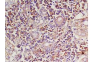 Formalin-fixed and paraffin embedded human laryngeal carcinoma labeled with Rabbit Anti-Cyclin E Polyclonal Antibody, Unconjugated (ABIN670311) at 1:200 followed by conjugation to the secondary antibody and DAB staining (Cyclin E1 抗体  (AA 375-411))