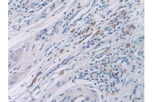 Detection of CDK2 in Human Colorectal cancer Tissue using Polyclonal Antibody to Cyclin Dependent Kinase 2 (CDK2) (CDK2 抗体  (AA 94-198))