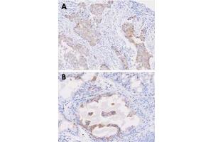Paraffin embedded sections of human breast cancer (A) and prostate hyperplasia tissue (B) were incubated with STEAP1 monoclonal antibody, clone J2D2  (1 : 50) for 2 hours at room temperature. (STEAP1 抗体  (AA 1-70))