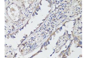 Immunohistochemistry of paraffin-embedded human lung cancer using NTRK2 antibody (ABIN6290695) at dilution of 1:200 (40x lens). (TRKB 抗体)