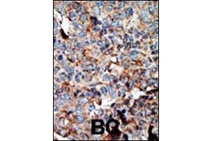 Formalin-fixed and paraffin-embedded human cancer tissue reacted with the primary antibody, which was peroxidase-conjugated to the secondary antibody, followed by AEC staining. (NME2 抗体  (N-Term))