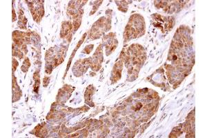 IHC-P Image TBCC antibody [N1C3] detects TBCC protein at cytosol on human breast carcinoma by immunohistochemical analysis. (TBCC 抗体)