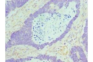 Immunohistochemistry of paraffin-embedded human ovarian cancer using ABIN7160088 at dilution of 1:100