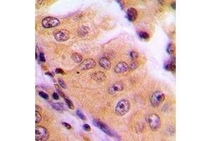 Immunohistochemical analysis of MGCRACGAP staining in human lung cancer formalin fixed paraffin embedded tissue section. (RACGAP1 抗体)