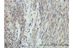 Immunoperoxidase of monoclonal antibody to DNM1L on formalin-fixed paraffin-embedded human leiomyosarcoma tissue. (Dynamin 1-Like 抗体  (AA 1-710))
