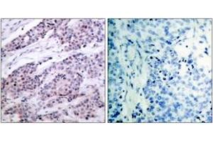 Immunohistochemistry analysis of paraffin-embedded human breast carcinoma tissue, using BCL-2 (Ab-56) Antibody. (Bcl-2 抗体  (AA 26-75))