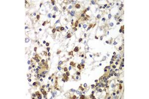 Immunohistochemistry of paraffin-embedded human kidney cancer using SND1 antibody (ABIN5973481) at dilution of 1/100 (40x lens). (SND1 抗体)