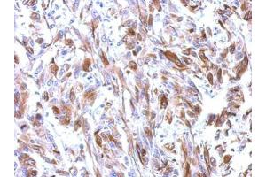 IHC-P Image Immunohistochemical analysis of paraffin-embedded U251 xenograft, using alpha Tubulin, antibody at 1:500 dilution. (TUBA1B 抗体)