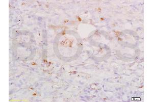 Formalin-fixed and paraffin embedded human lung carcinoma labeled with Anti-SP-D/PSPD Polyclonal Antibody, Unconjugated (ABIN731678) at 1:200, followed by conjugation to the secondary antibody and DAB staining. (SFTPD 抗体  (AA 301-375))