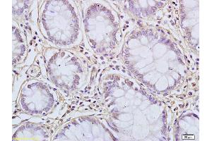 Formalin-fixed and paraffin embedded human colon carcinoma labeled with Anti-FUS Polyclonal Antibody, Unconjugated (ABIN682438) at 1:200 followed by conjugation to the secondary antibody and DAB staining (FUS 抗体  (AA 421-526))