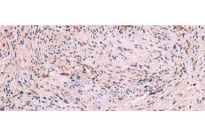Immunohistochemistry of paraffin-embedded Human cervical cancer tissue using MBTPS2 Polyclonal Antibody at dilution of 1:30(x200) (MBTPS2 抗体)