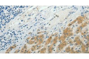 Immunohistochemistry of paraffin-embedded Human liver cancer using NDRG2 Polyclonal Antibody at dilution of 1:50 (NDRG2 抗体)