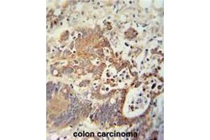 CHCHD2 antibody (Center) immunohistochemistry analysis in formalin fixed and paraffin embedded human colon carcinoma followed by peroxidase conjugation of the secondary antibody and DAB staining. (CHCHD2 抗体  (Middle Region))