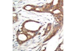 Immunohistochemical analysis of PER2 (pS662) staining in human prostate cancer formalin fixed paraffin embedded tissue section. (PER2 抗体  (pSer662))