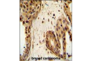 STAT2 Antibody immunohistochemistry analysis in formalin fixed and paraffin embedded human breast carcinoma followed by peroxidase conjugation of the secondary antibody and DAB staining.