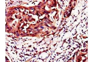 Immunohistochemistry of paraffin-embedded human bladder cancer using ABIN7162131 at dilution of 1:100 (Uncharacterized Protein C4orf26 (ODAPH) (AA 24-130) 抗体)