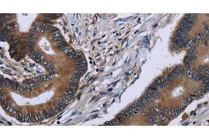 Immunohistochemistry of paraffin-embedded Human colon cancer tissue using ITGAE Polyclonal Antibody at dilution of 1:60