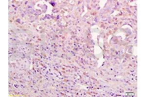 Formalin-fixed and paraffin embedded human ovarian carcinoma labeled with Anti-Aurora A/ARK-1/AURKA Polyclonal Antibody, Unconjugated (ABIN750053) at 1:200 followed by conjugation to the secondary antibody and DAB staining. (Aurora A 抗体)