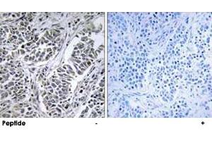 Immunohistochemistry analysis of paraffin-embedded human lung carcinoma tissue using ATP5D polyclonal antibody . (ATP5F1D 抗体)