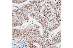 Immunohistochemistry of paraffin-embedded human endometrium cancer using RBM17 antibody (ABIN6133103, ABIN6146765, ABIN6146766 and ABIN6220171) at dilution of 1:100 (40x lens). (RBM17 抗体  (AA 1-240))